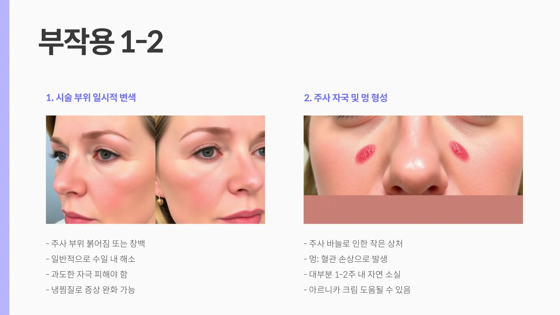 팔자주름 보톡스 부작용 이미지 4